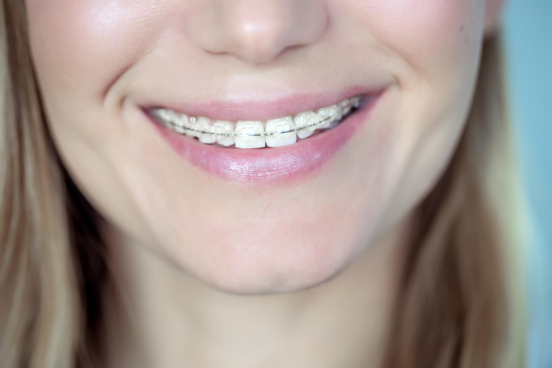 medium-vecteezy_adult-woman-with-a-braces_36454654_medium (1)